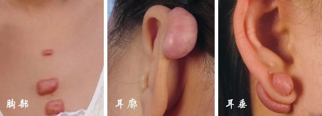 瘢痕体质做手术会不会留疤?