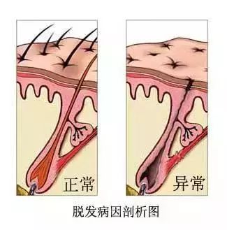 脂溢性脱发和皮脂溢出有关,是脱发的常见类型.