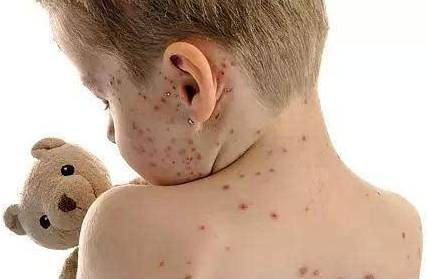 水痘,不单单只感染儿童
