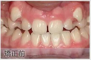 儿童牙齿矫正需要拔牙吗?