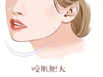 脸大,咬肌肥大怎么办?