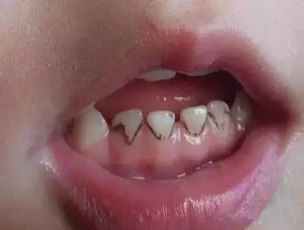 发现孩子牙齿上有小黑点,不用慌