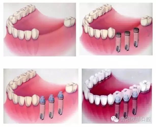 种植牙的适应症和禁忌症