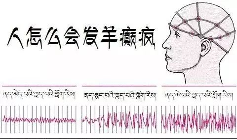 人怎么会发羊癫疯?