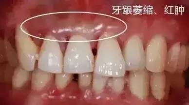 牙龈萎缩是什么原因导致的?