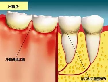 牙周炎的7个典型症状