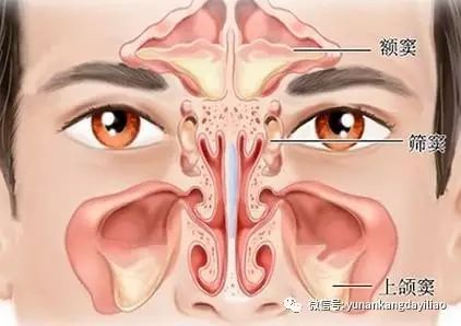 1,急性鼻窦炎:鼻腔炎症经鼻窦开口向鼻窦内蔓延,引起急性化脓性鼻窦炎