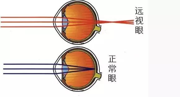 详解近视,散光,远视,斜视及弱视