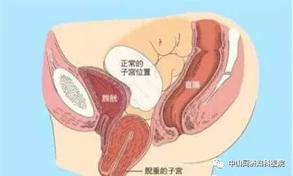 因为子宫脱垂多伴阴道口松驰,阴道前后壁膨出,会阴肌群较薄弱,性交时