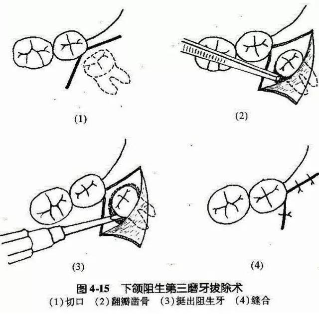 智齿及拔牙有哪些注意事项?