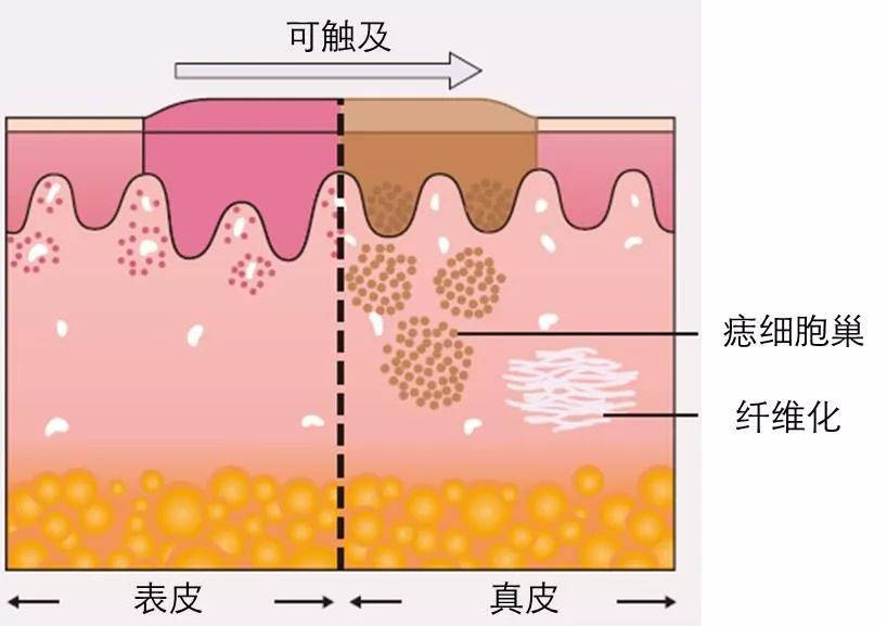 丘疹或斑块,可触及,例如银屑病,扁平苔藓,皮内痣,复合痣,肥厚性瘢痕