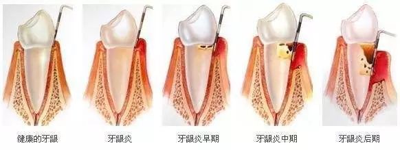 洗牙和牙周刮治有什么区别?