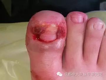 甲沟炎类型与症状有哪些?