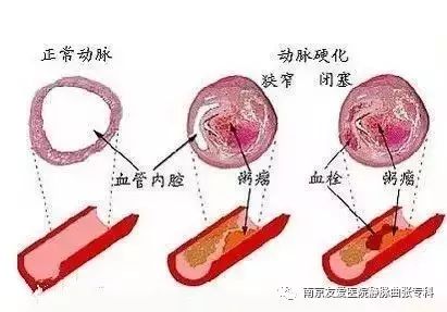 动脉硬化是什么原因引起的?