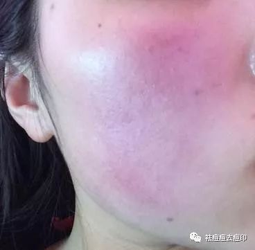 皮肤发炎也会引起红血丝肌肤吗?