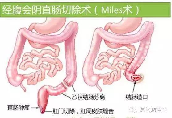 遭遇直肠癌,该如何选择手术方式?