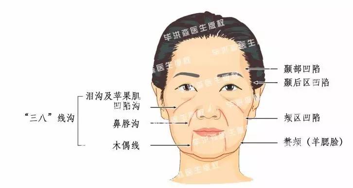 面部浅层脂肪分布主要在中面部,颈部,是引起中,下面部下垂的主要
