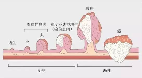 直肠息肉的良恶之辩