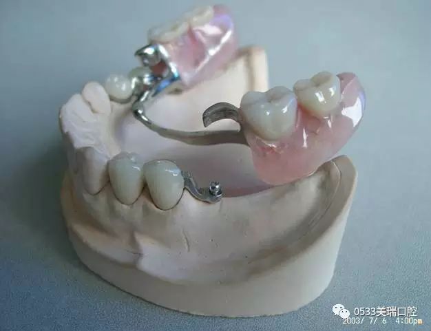 镶牙有哪些种类