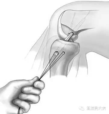 膝关节扭伤不能忽视