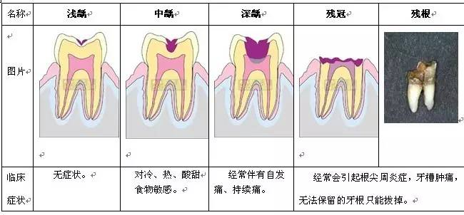 急性牙髓炎症状_急性牙髓炎