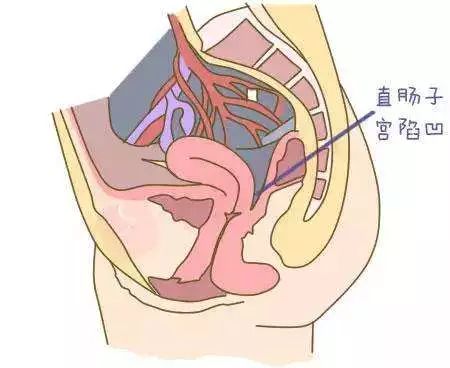 正常情况下,女性盆腔内的腹膜从膀胱返折至子宫,最后再返折至直肠前壁