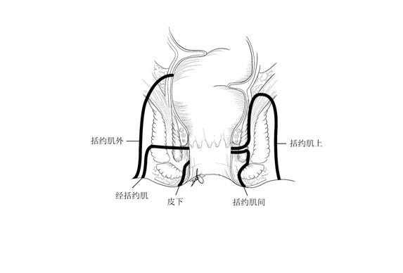 克罗恩病肛瘘与普通肛瘘究竟有何不同?