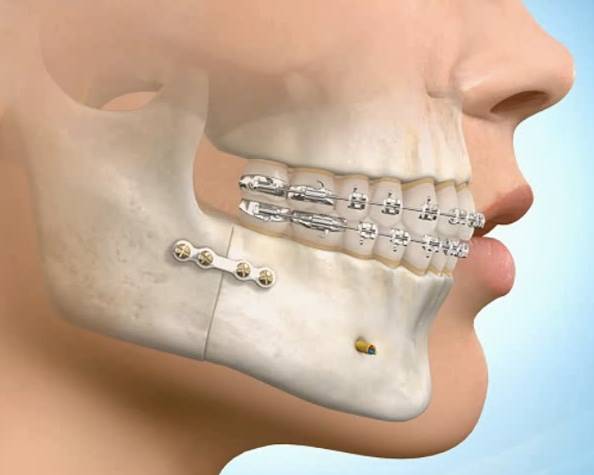 单纯通过牙齿移动无法达到满意效果的患者,大致流程是先矫正,再手术