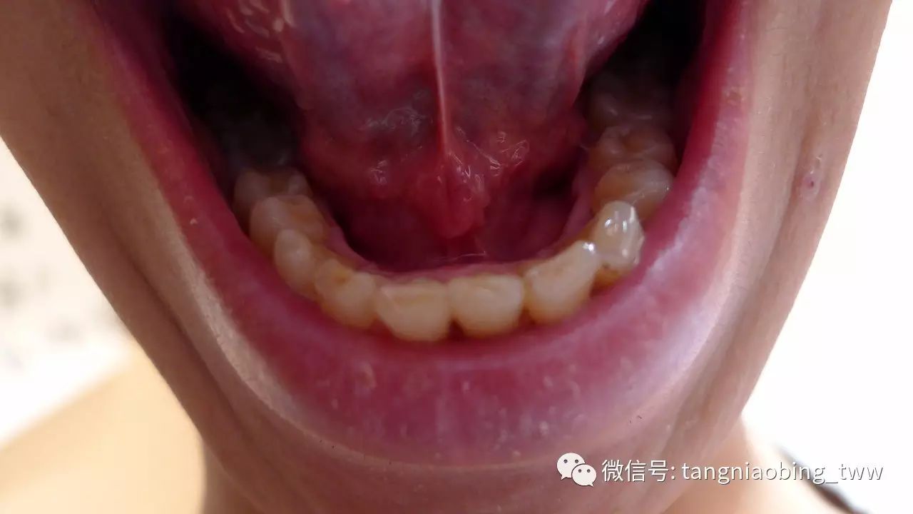 将舌头翘起,舌尖抵上颚,可以看到舌底左右各有一条络脉.