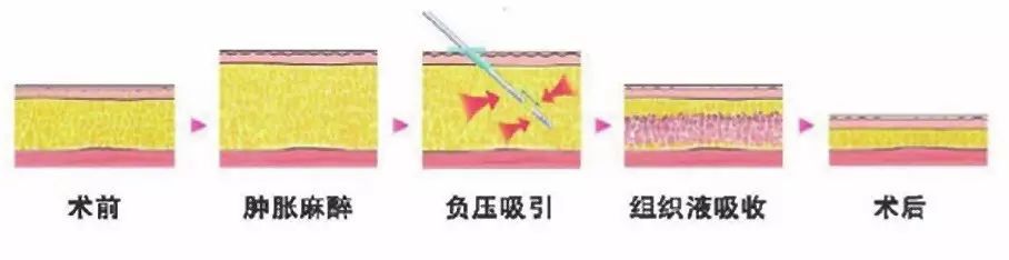 吸脂原理:   目前采用的是负压吸脂的方法,手术麻醉后,注入肿胀液