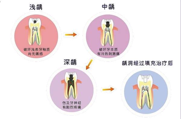 龋病发生的四大原因