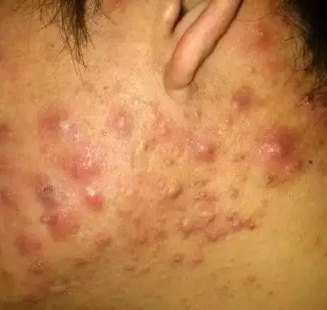 长痘痘是一种毛囊阻塞发炎的现象.