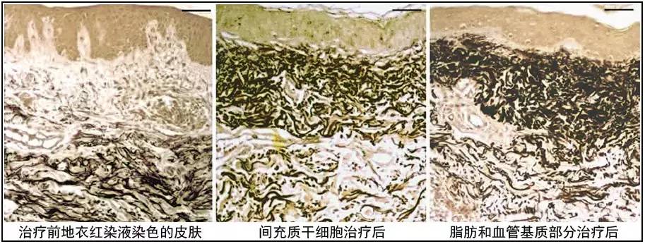两种治疗之后,弹性纤维明显增多,染色黑,定位于真皮浅层.
