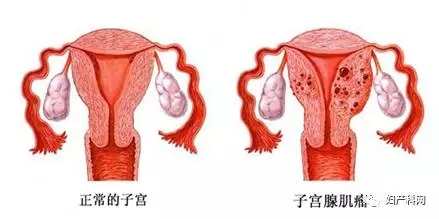 子宫腺肌病是什么