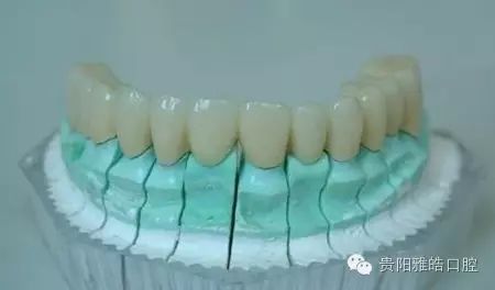烤瓷牙一般可以用多少年?