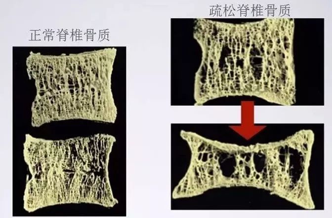 原发性骨质疏松 人体骨量在35岁左右达到最高峰,此后,成骨细胞减少,破