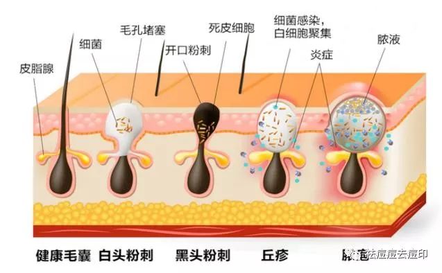 粉刺和痘痘,分别要怎么去除?