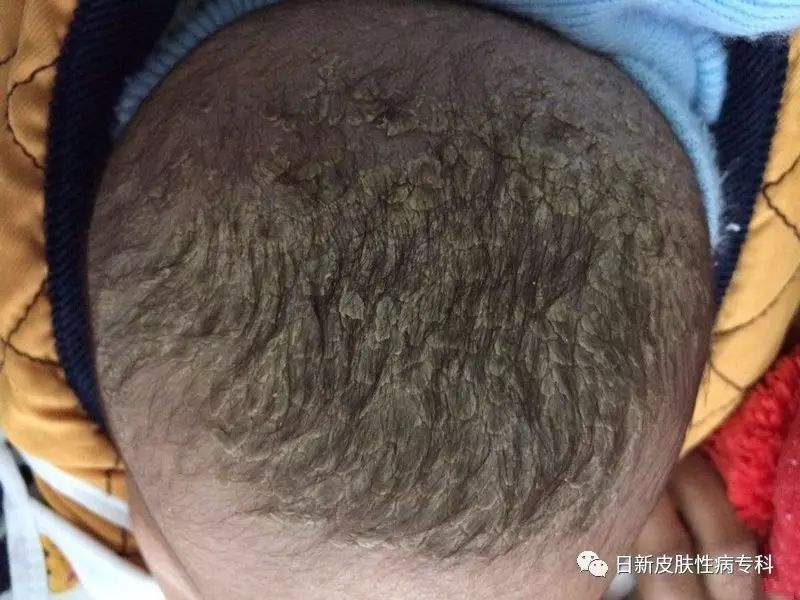 ڼҪעϴ,ΪͷƤĲ費Ӱ챦ͷ