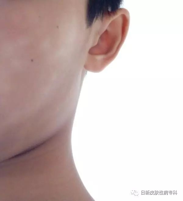 高发的儿童皮肤病有哪些?