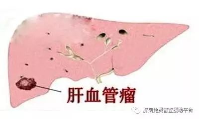 肝血管瘤属于良性肿瘤吗?