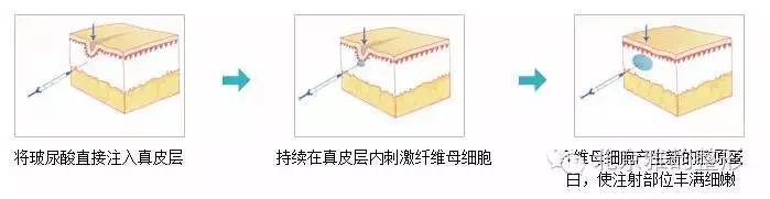 玻尿酸塑形原理