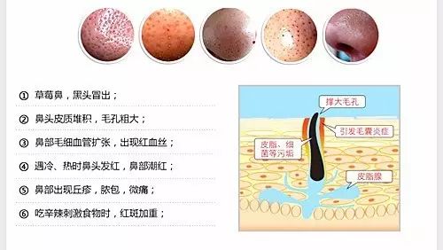 酒糟鼻症状