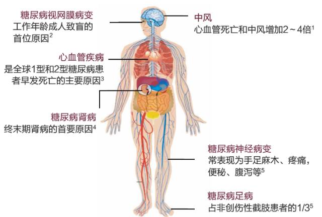 糖尿病慢性并发症