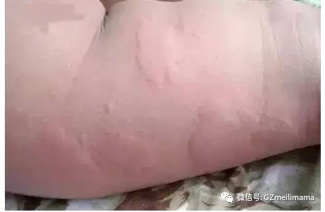 宝宝身上突然冒出的这些皮疹你以为是湿疹?