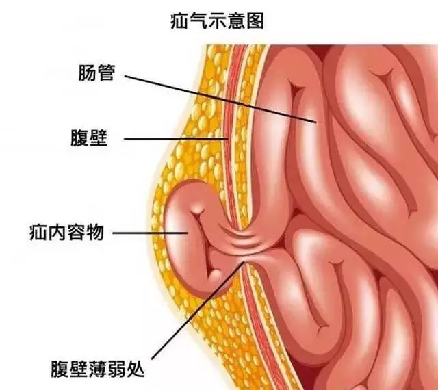 腹外疝的种类