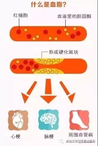 胆固醇又有低密度脂蛋白胆固醇(俗称"坏"胆固醇)和高密度脂蛋白胆固醇
