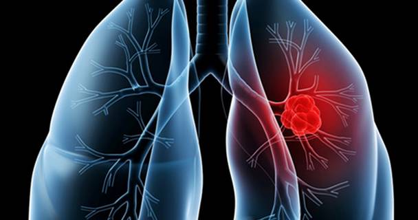 早中期肺癌治愈率高吗?