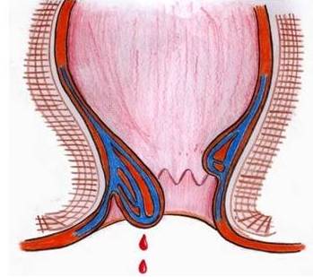 痔疮不治疗会有哪些危害?