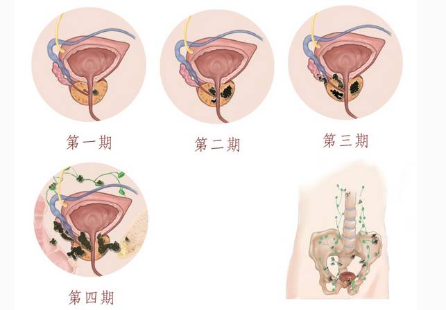 患前列腺癌要注意什么呢?