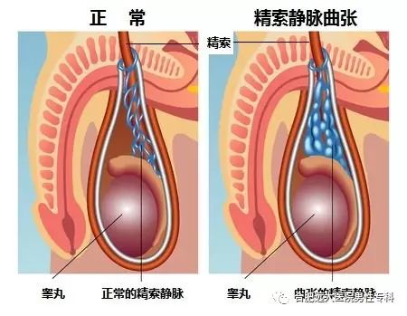 男人"蛋疼"警惕精索静脉曲张!